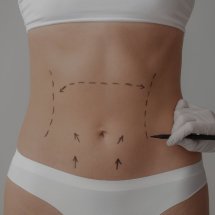 Abdominoplastia Hd e RAFT