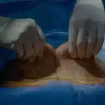 Abdominoplastia