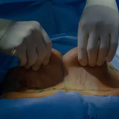 abdominoplastia_em_curitiba