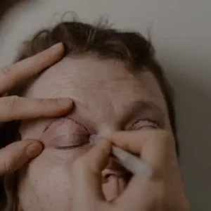 procedimento_blefaroplastia_curitiba