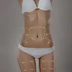 Lipoaspiração
