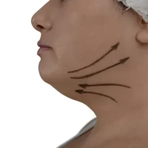 lipoaspiracao_de_papada