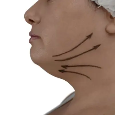 lipoaspiracao_de_papada
