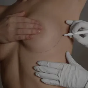 reducao_mamas_mamoplastia_redutora_curitiba