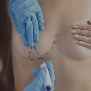 mastopexia_elevacao_mamas